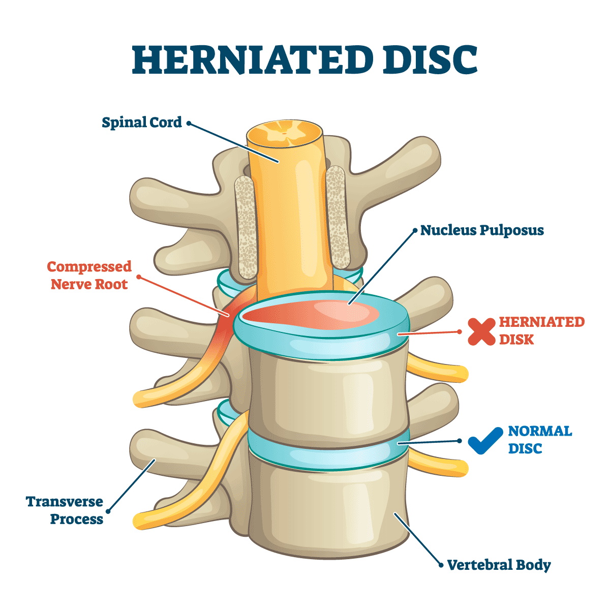 herniated disc anatomy