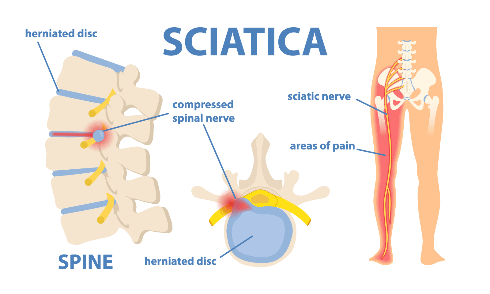 sciatica anatomy