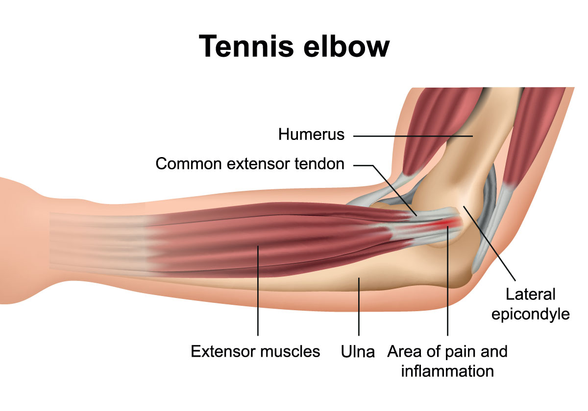 anatomy of tennis elbow