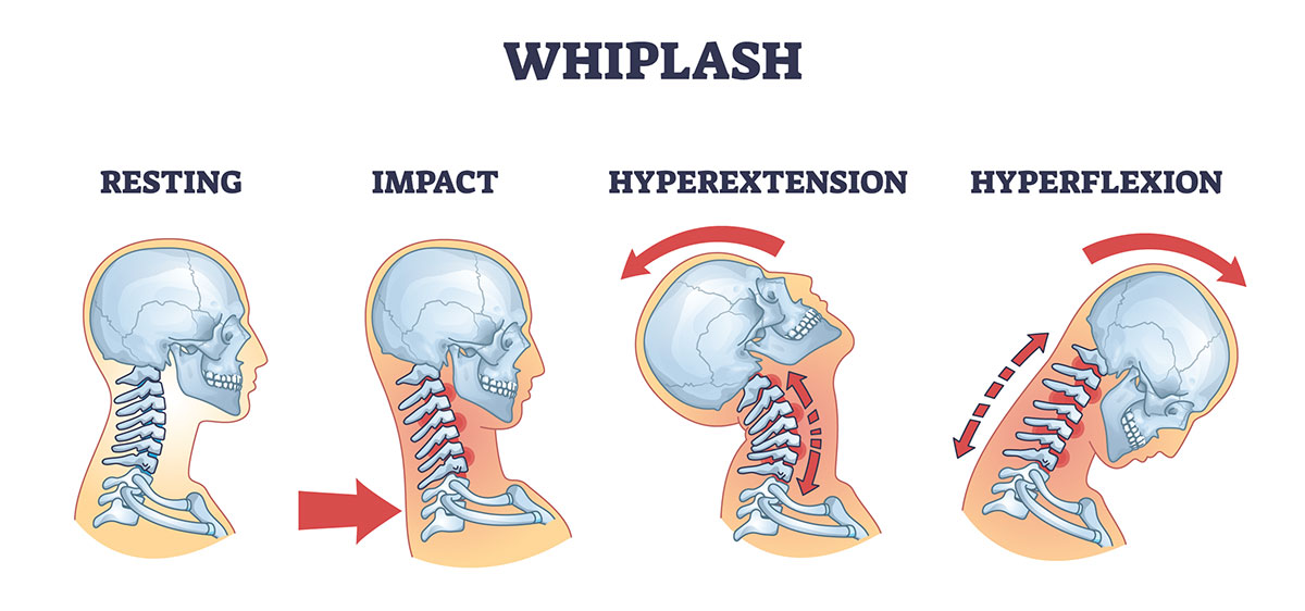 whiplash neck movement