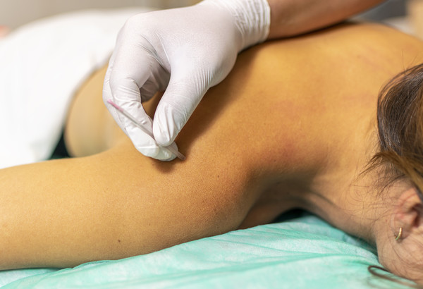 Dry Needling near Virginia Beach