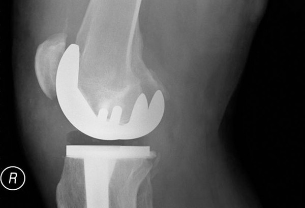 Total Joint Replacement