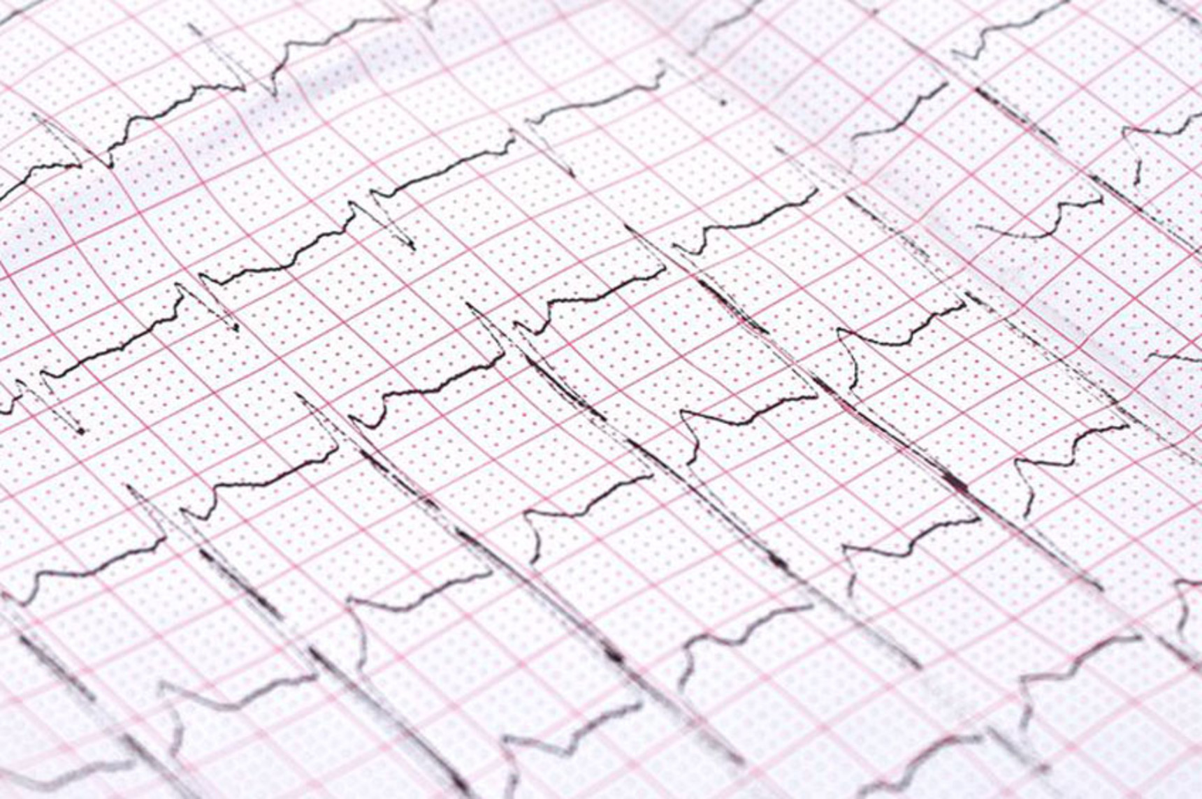 What is involved in a neurological nerve conduction test?